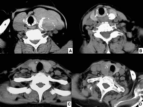 Calcifications In Thyroid Nodules Identified On Preoperative Computed