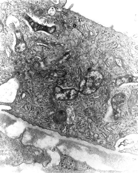 picture disease scrub typhus river flood typhus