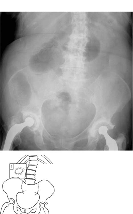 Emphysematous cholecystitis | Radiology Key