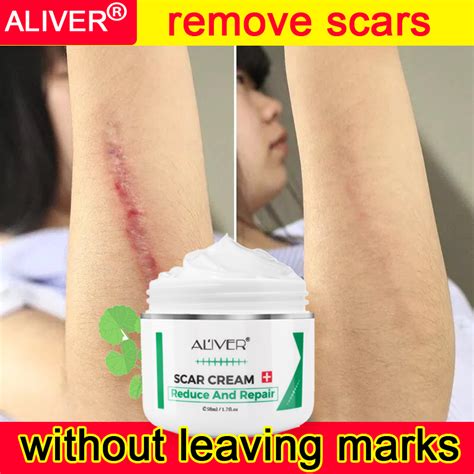 Aliver Scar Removal Cream 50ml Scar Remover For Old Scar On Leg Scars