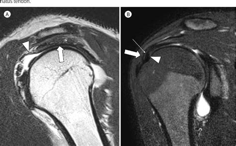 Figure 2 From Partial Thickness Tear Of Supraspinatus And