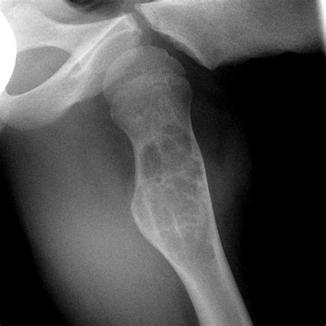 Unicameral Bone Cyst Femur Image