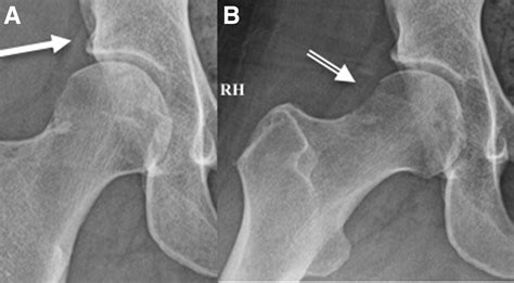 Arthroscopic Assisted Intraosseous Bioplasty Of The Acetabulum