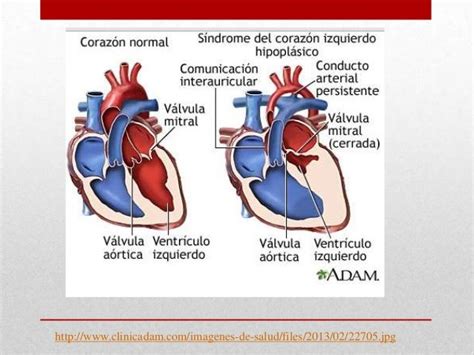 Malformaciones Congenitas De Corazón