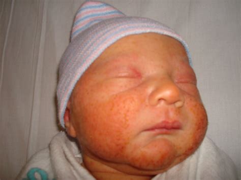 newborn hives - pictures, photos