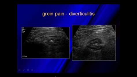 Ultrasound of hernias Diverticulitis, Ultrasound, Abdominal, Medical, Medicine, Med School ...