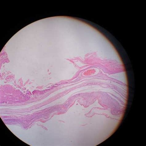 Scanner View Showing Hande 50x Dermoid Cyst Lining On The Right And