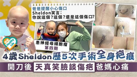 生命鬥士︳4歲sheldon歷5次手術全身疤痕 開刀後天真笑臉談傷疤爸媽心痛 晴報 健康 腫瘤及癌症 D220117