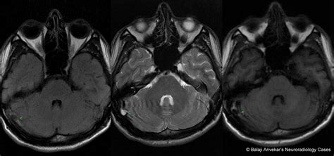 Dr Balaji Anvekar FRCR: Giant Arachnoid granulation