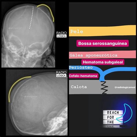 Cefalohematoma E Bossa