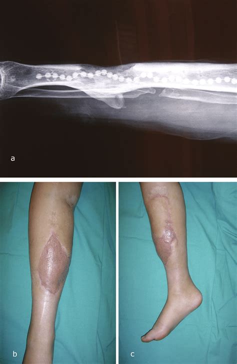 Case Example From M Group Muscular Latissimus Dorsi Flap With