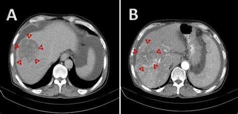 A B Ct Imaging Showing A Mass In A Cirrhotic Liver With Mosaic Download Scientific Diagram