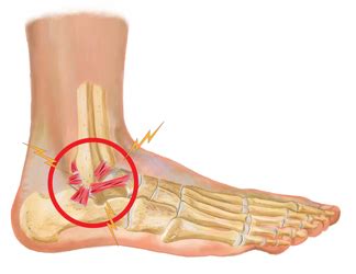 Ankle Ligament Injury