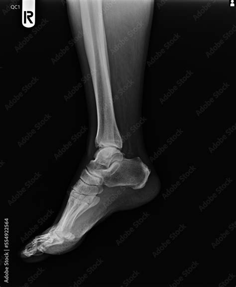 Film x-ray of ankle . Lateral view Stock Photo | Adobe Stock