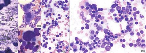 Bone marrow biopsy from June 2018. Description of bone marrow biopsy ...