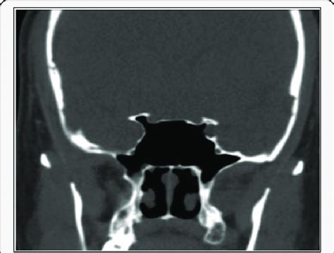 Shows The Carotid Artery Projecting Partially Into The Sphenoid Sinus