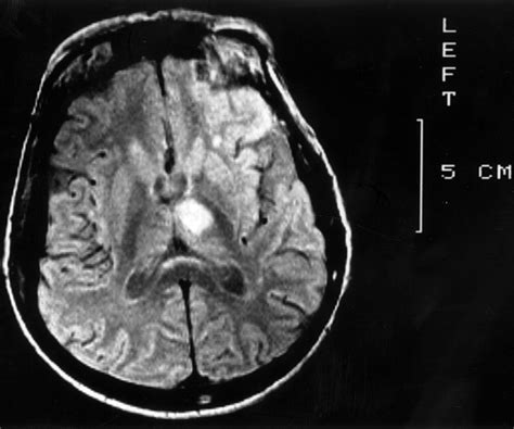 Diencephalic amnesia and apraxia after left thalamic infarction ...