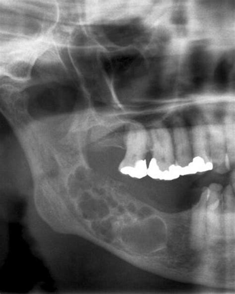 Odontogenic Keratocyst Radiology