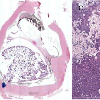 Pathology of the enucleated eye. A, Gross photograph of the enucleated ...