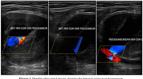 Figure 1 from Surgical treatment of femoral artery pseudoaneurysm after cardiac catheterization ...