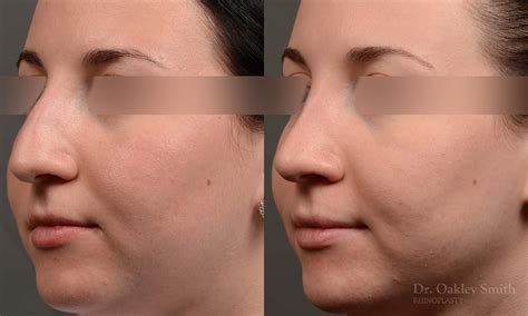 430d Rhinoplasty Dr Oakley Smith Toronto Top Surgeon Nose Job