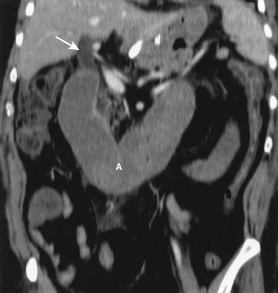 Postoperative Small Bowel | Radiology Key