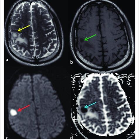 Susceptibility Artifact Dwi Through The Petrous Apex Shows Linear High