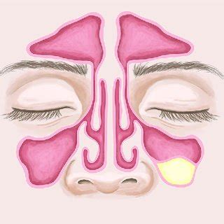 (PDF) Are mucous retention cysts and pseudocysts in the maxillary sinus ...