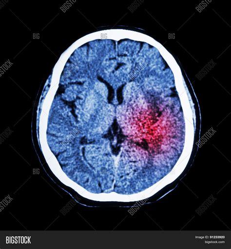 Ct Scan Brain Show Image & Photo (Free Trial) | Bigstock