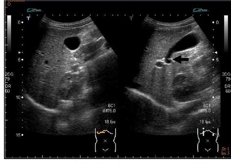 Common Hepatic Duct Diagram