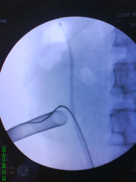 Intraoperative Fluoroscopic Image Showing Access To The Lower Pole