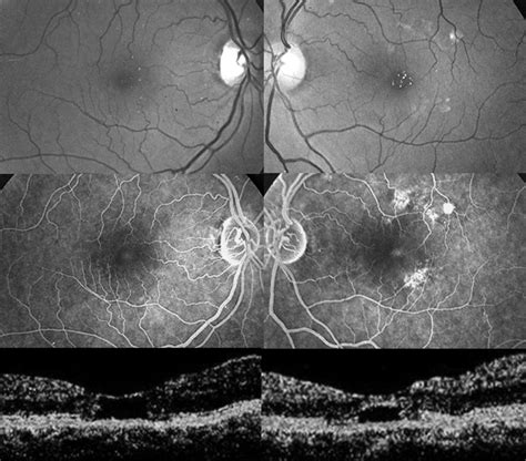 Optical Coherence Tomography Findings In Tamoxifen Retinopathy