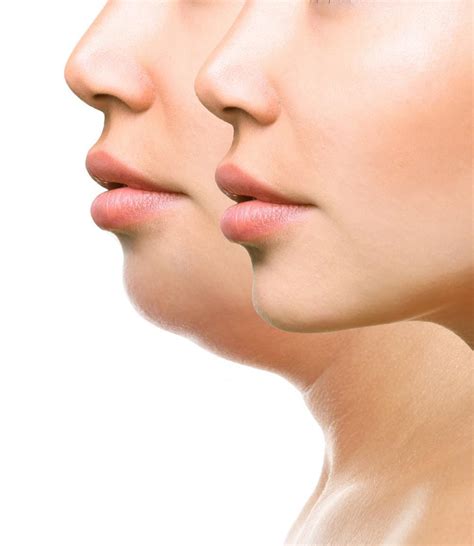 Say Goodbye To Your Double Chin Radiance Dermatology Cosmetic Dermatology