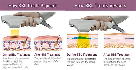 Why You Need to Try a BBL Treatment – Ready Set Beauty