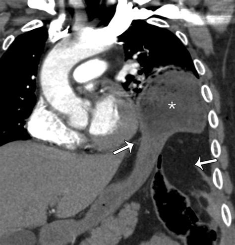 Multidetector CT Of Blunt Thoracic Trauma RadioGraphics