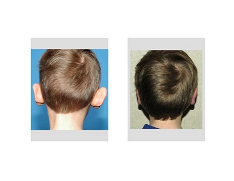 eppley-otoplasty-back-view - Explore Plastic Surgery