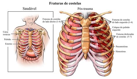 Fratura da costela no tòrax sintomas tratamento e tempo de recuperação