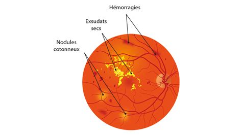 La rétinopathie diabétique Hôpital ophtalmique Jules Gonin