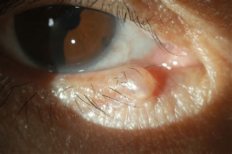 Lump On Lower Eyelid