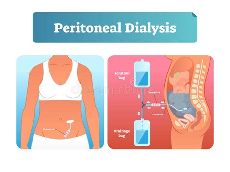 Continuous Ambulatory Peritoneal Dialysis Stock Vector Illustration