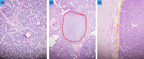 A Well‐differentiated Pancreatic Neuroendocrine Tumor B Separate Download Scientific