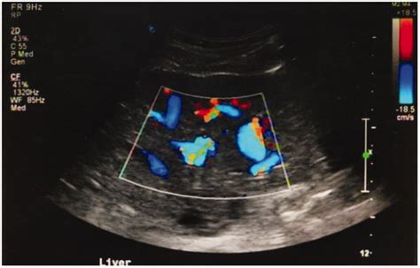 Transabdominal ultrasound examinations of a 43-year-old female patient,... | Download Scientific ...