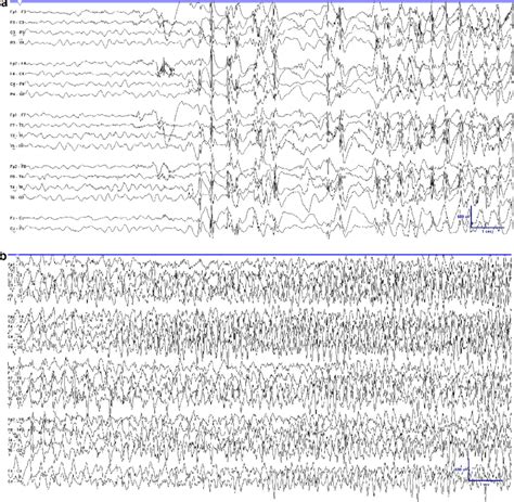 A clinically focal onset seizure in an 18-month-old girl with... | Download Scientific Diagram