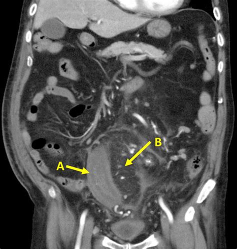 A Case Of Mesenteric Panniculitis Requiring An Operation Bmj Case Reports