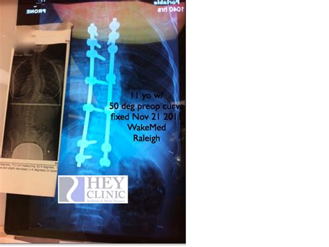 11 Yo With 50 Degree Early Onset Scoliosis Eos Idiopathic Curve Fixed