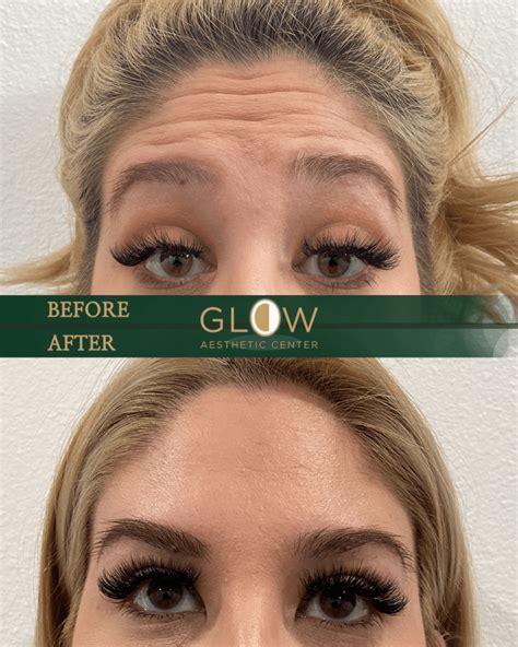 Botox Glow Aesthetic Center