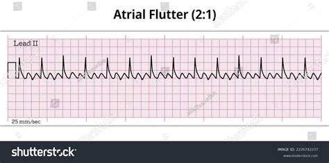 Ecg Atrial Flutter 21 8 Second Ecg Paper Royalty Free Stock