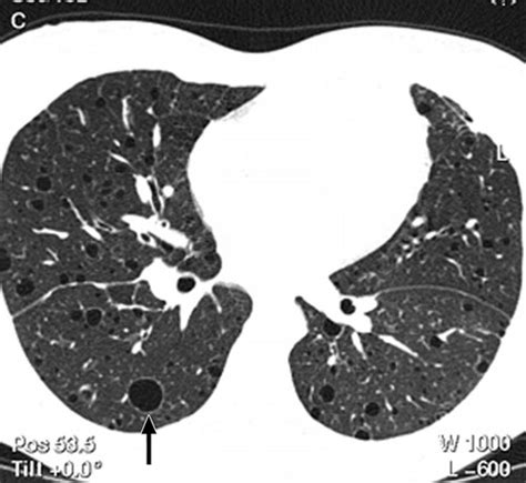 Lymphangioleiomyomatosis Pulmonary And Abdominal Findings With