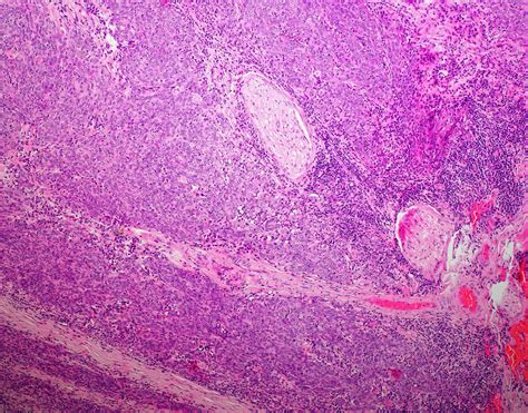 Poorly Differentiated Squamous Cell Carcinoma Of The Larynx With