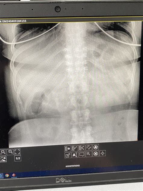 F35. I haven’t pooped in 10 days. : r/AskDocs